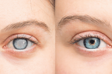 Cataract Surgery can cause aniseikonia