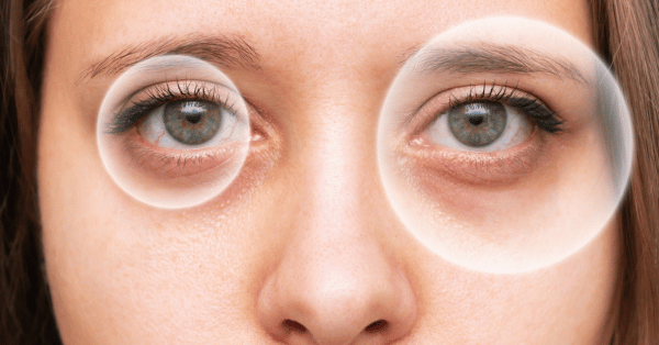 What is Aniseikonia and how to prevent it